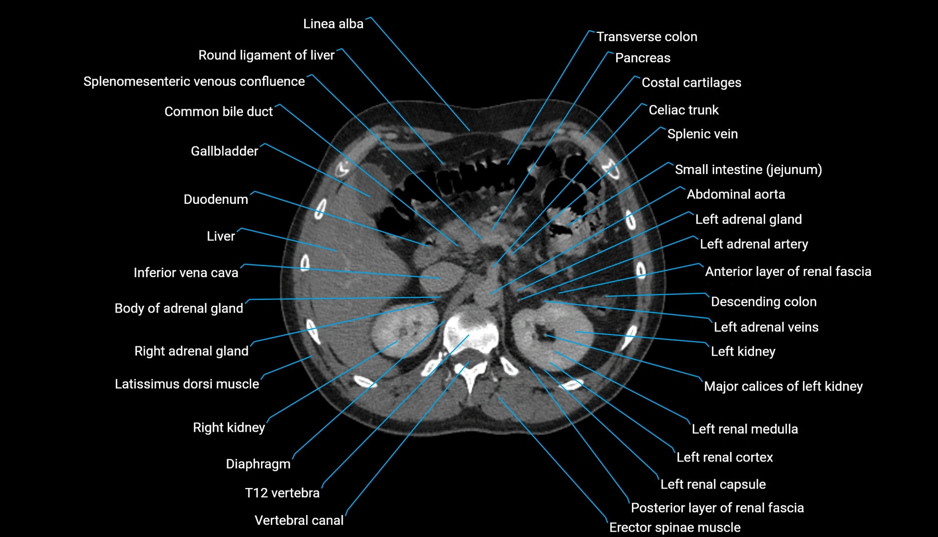 CT urogram axial cross sectional anatomy  labelled radiology image-00085.webp